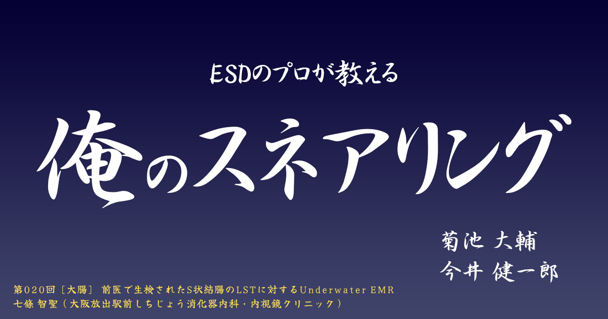 ESDのプロが教える「俺のスネアリング」　 第020回 [大腸] 前医で生検されたS状結腸のLSTに対するUnderwater EMR　 七條 智聖（大阪放出駅前しちじょう消化器内科・内視鏡クリニック）